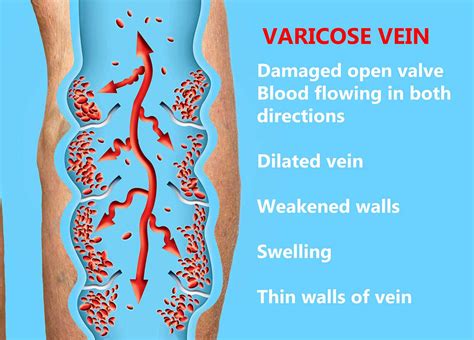 Causes Of Vascular Disease In The Legs Dr Mackay Of Tampa