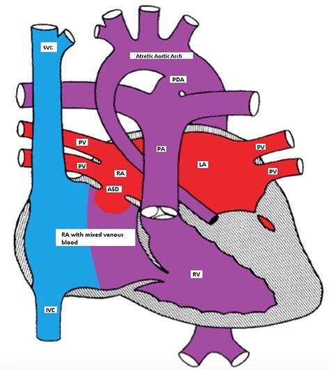 Cyanotic Cardiac Lesions