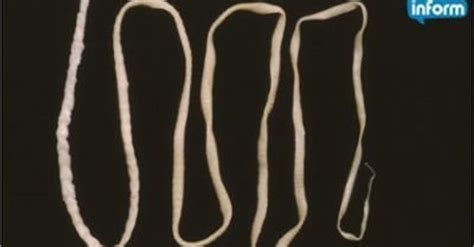 Wiggling Tapeworm Larva Found Deep Inside California Mans Brain