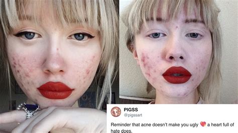 The Acne Positivity Movement Takes Back The Shame From Breakouts