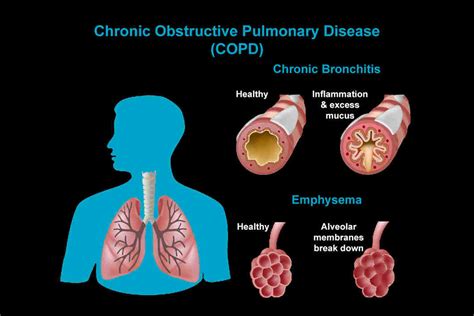 Copd Symptoms Causes Types Treatment And Prevention