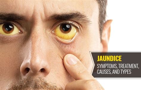 Jaundice Causes Treatment And Symptoms Reca Blog