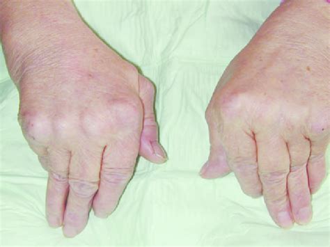 Ulnar Deviation Of Four Digits From Each Hand The Thumbs Show A