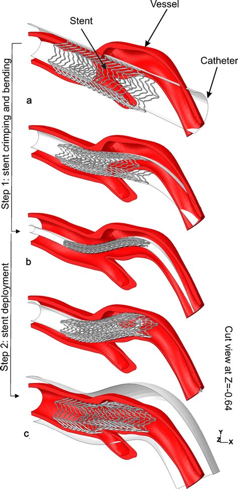 Figure 4 From Carotid Artery Stenting Simulation From Patient Specific