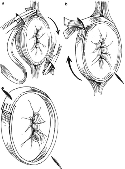 Rectal Prolapse Springerlink