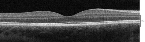 Optical Coherence Tomography Oct In Mississauga In Mississauga On