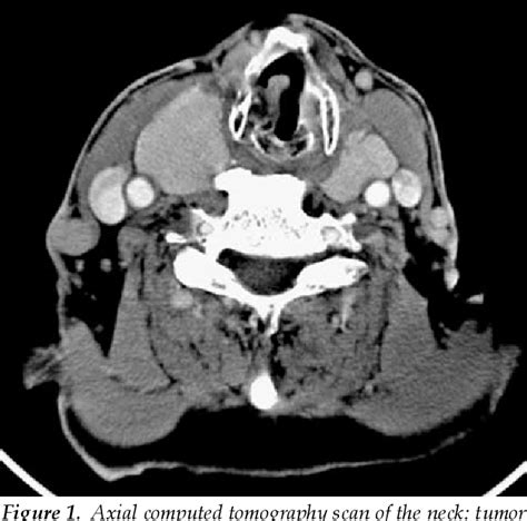 Figure 1 From Laryngeal Leiomyosarcoma With Coexistent Tuberculous