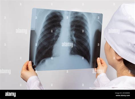 Un médecin examine une radiographie des poumons d un patient atteint de
