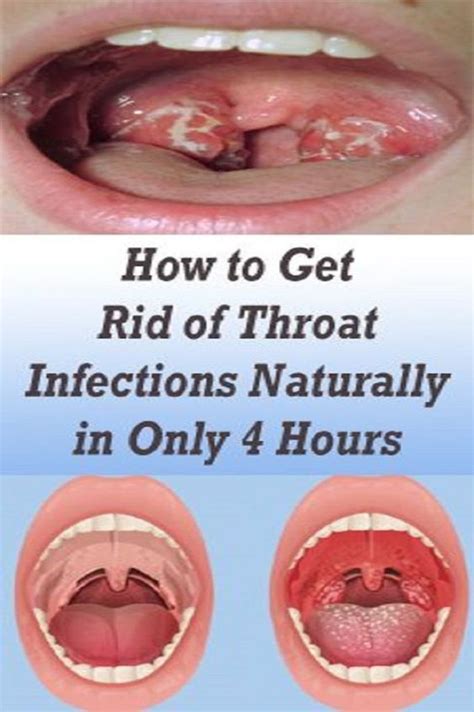 Instructions To Get Rid Of Throat Infections Naturally In Only 4