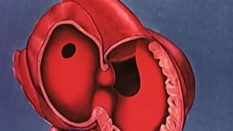 Koarktácia aorty Zdravotéka