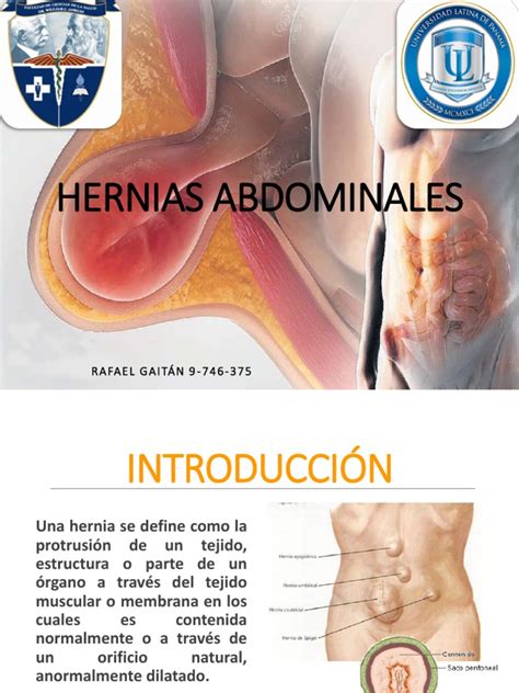 Hernias Abdominales Terminada Abdomen Peritoneo
