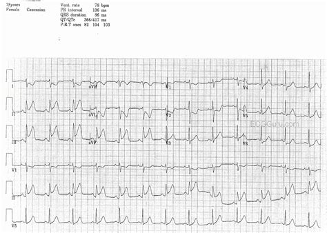 Inferior Wall M I Ecg Guru Instructor Resources