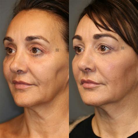 Before After Thread Lift Procedures Thread Lift Docto