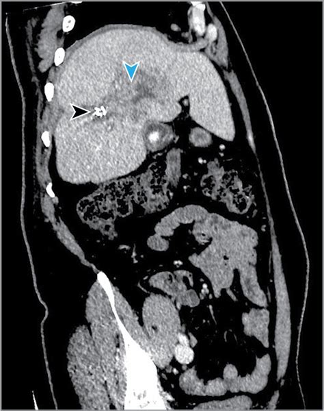 Acute Calculous Cholecystitis With Intrahepatic Gallbladder Perforation