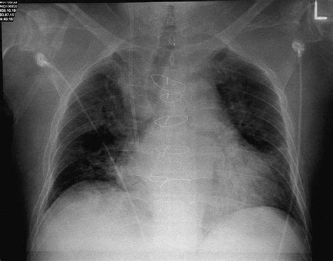 Study Medical Photos Congestive Cardiac Failure As Seen On Chest X Ray