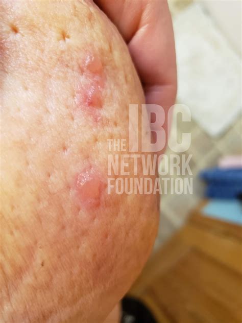 Pictures Of Inflammatory Breast Cancer The Ibc Network Foundation