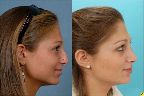Rhinoplasty Johns Hopkins Facial Plastic And Reconstructive Surgery