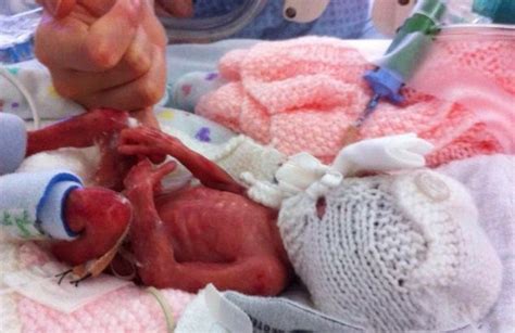 This Premature Babys Life Was Saved When Doctors Found A Pair Of