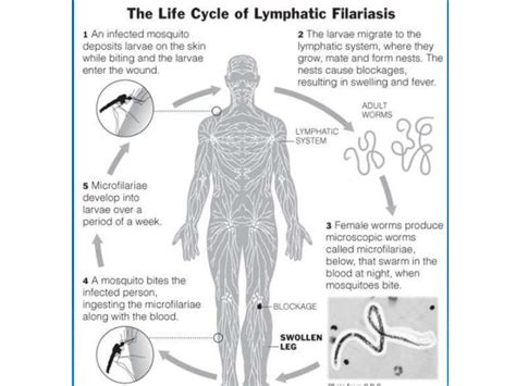 Filariasis Online Presentation