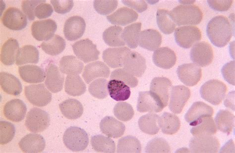 Public Domain Picture This Thin Film Micrograph Depicts A Plasmodium