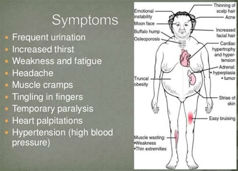 Conn S Syndrome Definition Etiopathogenesis Symptoms Clinical