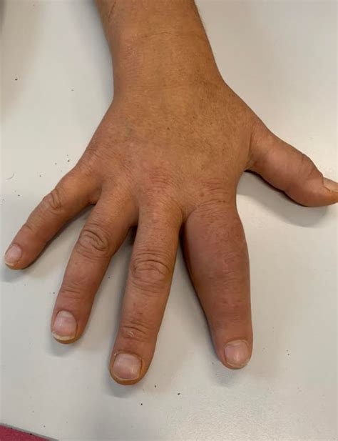 A psoríase é uma doença dermatológica, autoimune, que. Artrite Psoriática: o que é e qual a sua relação com a ...