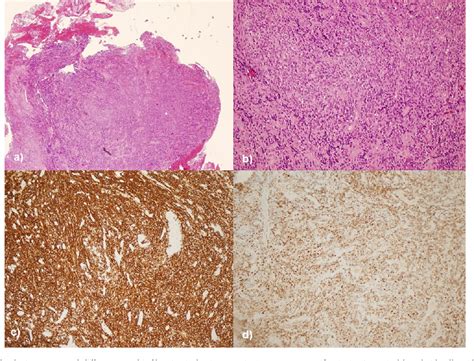 Primary Diffuse Large B Cell Lymphoma Of The Sigmoid Colon Semantic