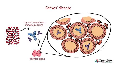 Graves Disease Diagram