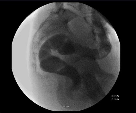 Lower Gi Prior To Colostomy Closure Demonstrating Continuity Without