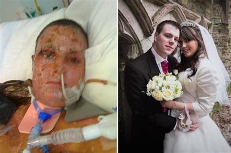 Burn Victim Who Was Engulfed In Fireball Learns To Walk Again To Marry