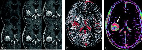 Dynamic Contrast Enhanced Ct Of Human Brain Tumors Quantitative