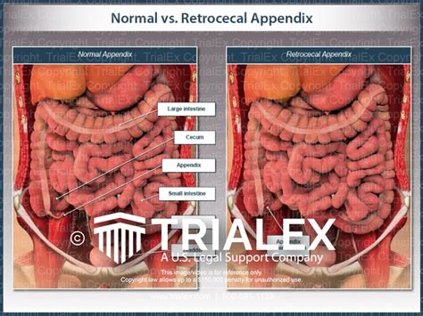 normal vs retrocecal appendix trial exhibits inc