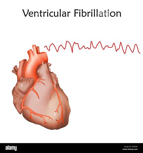 Ventricular Fibrillation Hot Sex Picture
