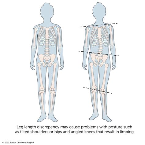 Leg Length Discrepancy Condition With Imbalanced Skeleton Outline