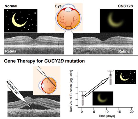 Gene Therapy Rapidly Improves Night Vision In Adults With Congenital