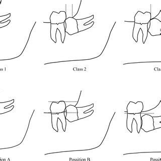 Classifications of impacted teeth allow defining the type and degree of retention, as well as assessing the degree of difficulty of the procedure. (PDF) Sustained-release lidocaine sheet for pain following ...