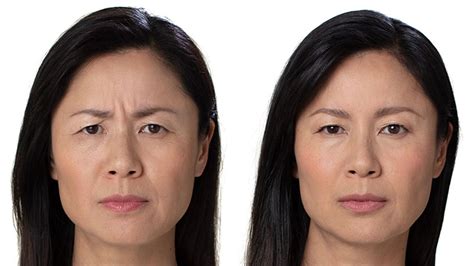 5 Top Ways To Erase Forehead Lines Laser Skin Resurfacing Botox® Skin Tightening And More