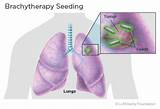 Lung Cancer Treatment In Israel Images