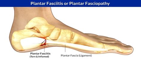 Reading Pa Plantar Fasciitis And Heel Pain Relief By Chiropractor Local