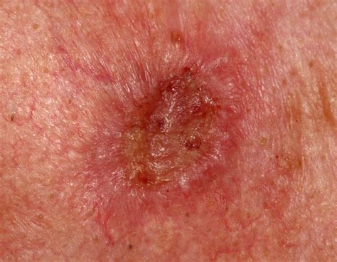 Skin Cancer Types Squamous Cell Carcinoma