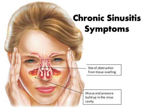 Is Teeth Hurting A Sign Of Sinus Infection