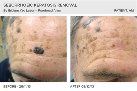 Before And After Gallery Skin Surgery Clinic