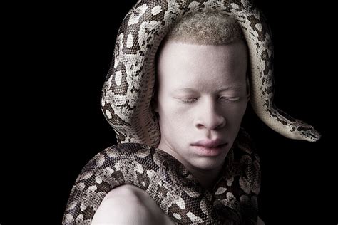 Models With Albinism Challenge Standards Of Beauty In Photographs By
