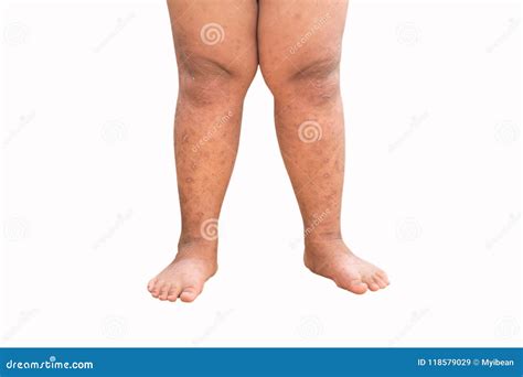 Mosquito Bite Sore And Scar On Kid Legs On White Background Stock Image