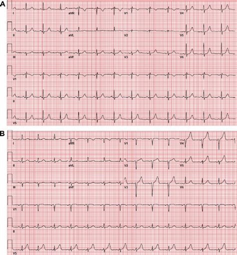 Normal 12 Lead Ecg