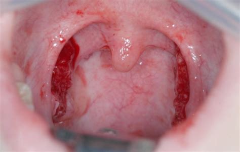 Tonsillitis Pictures What Does Tonsillitis Look Like Findatopdoc