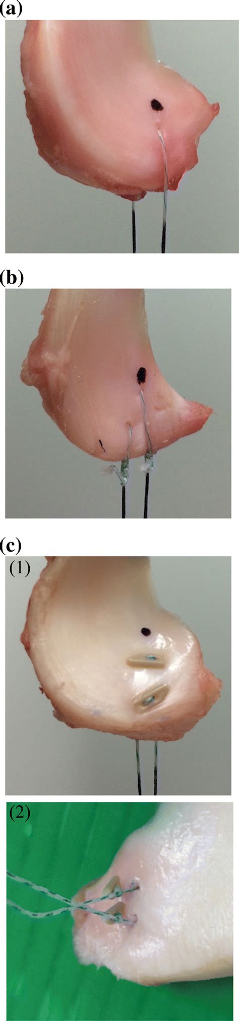 Biomechanical Comparison Of Meniscus Suture Constructs For Pullout Repair Of Medial Meniscus
