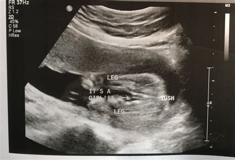 Update Boy 20 Week Ultrasound Definitely A Girl Babycenter