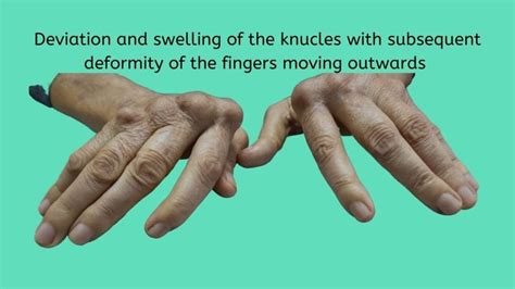 How To Know If You Have Rheumatoid Arthritis And To Manage It
