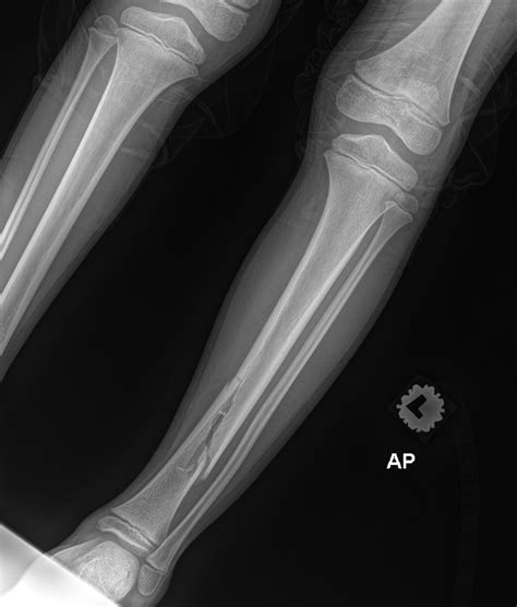 Closed Fracture Of Left Distal Tibia In A Young Boy Uni Clinic